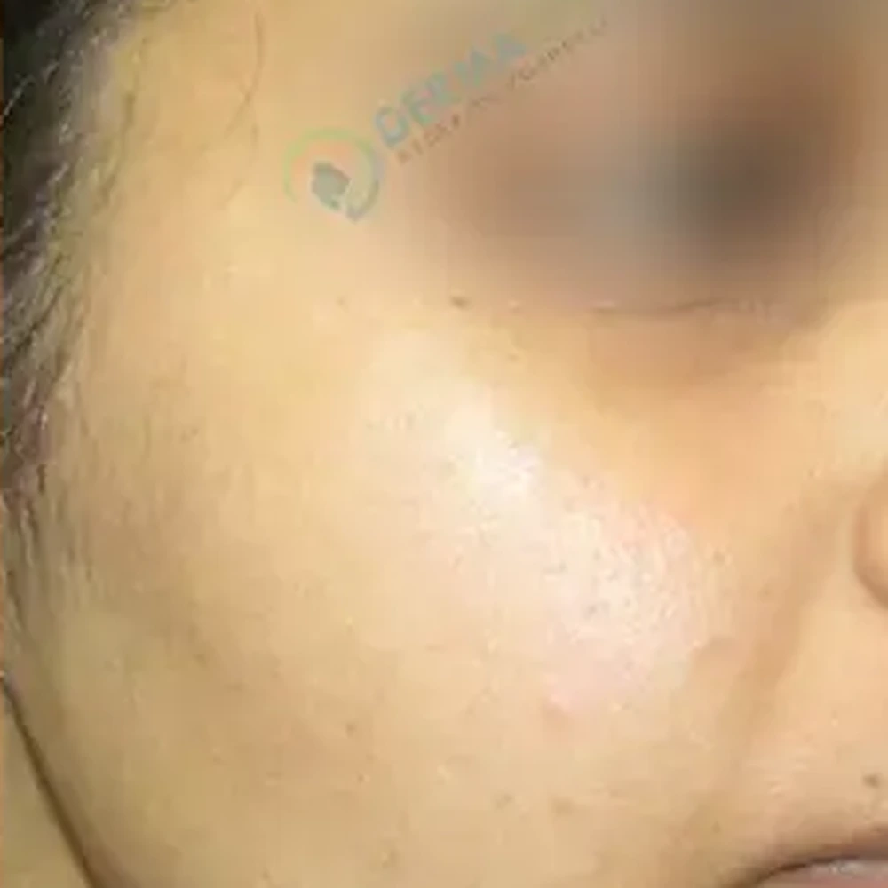 After Mole Removal Warts, Skin Tags and Safety