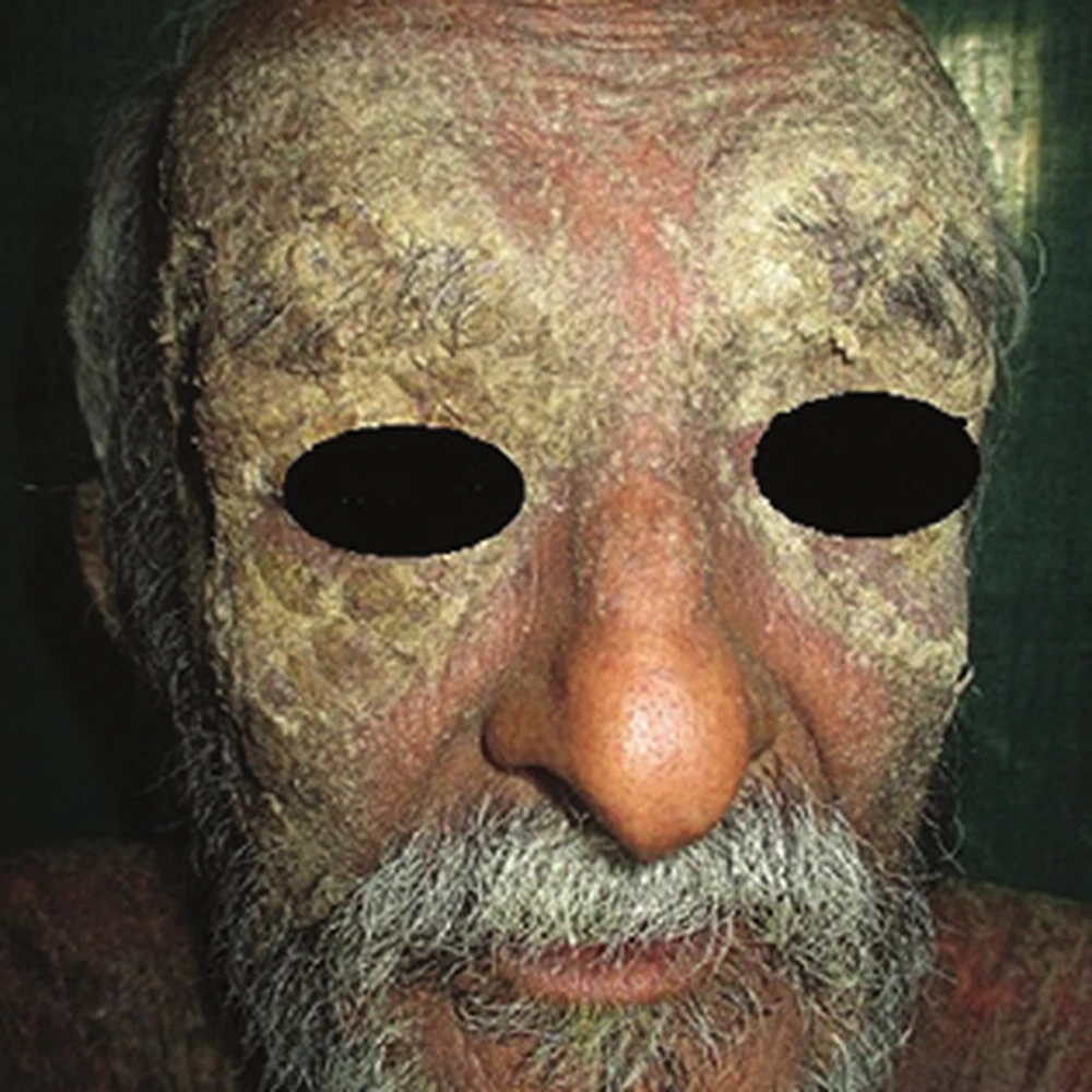 Before Scabies Treatment