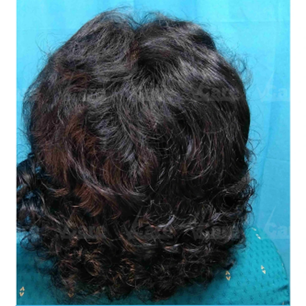 After Exosome Hair Therapy