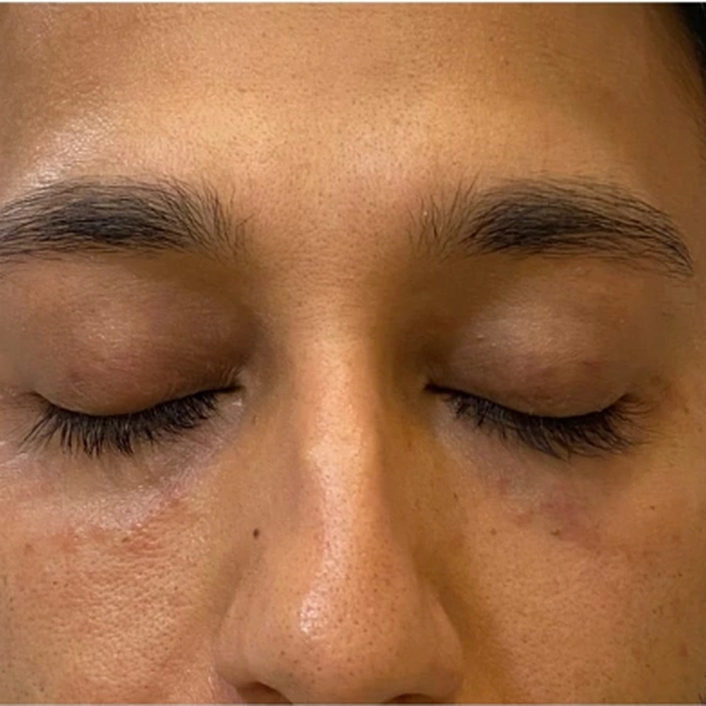 After Eye Filler Treatment for Hollow Eyes