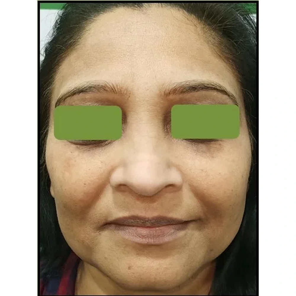 Before Dermal Fillers