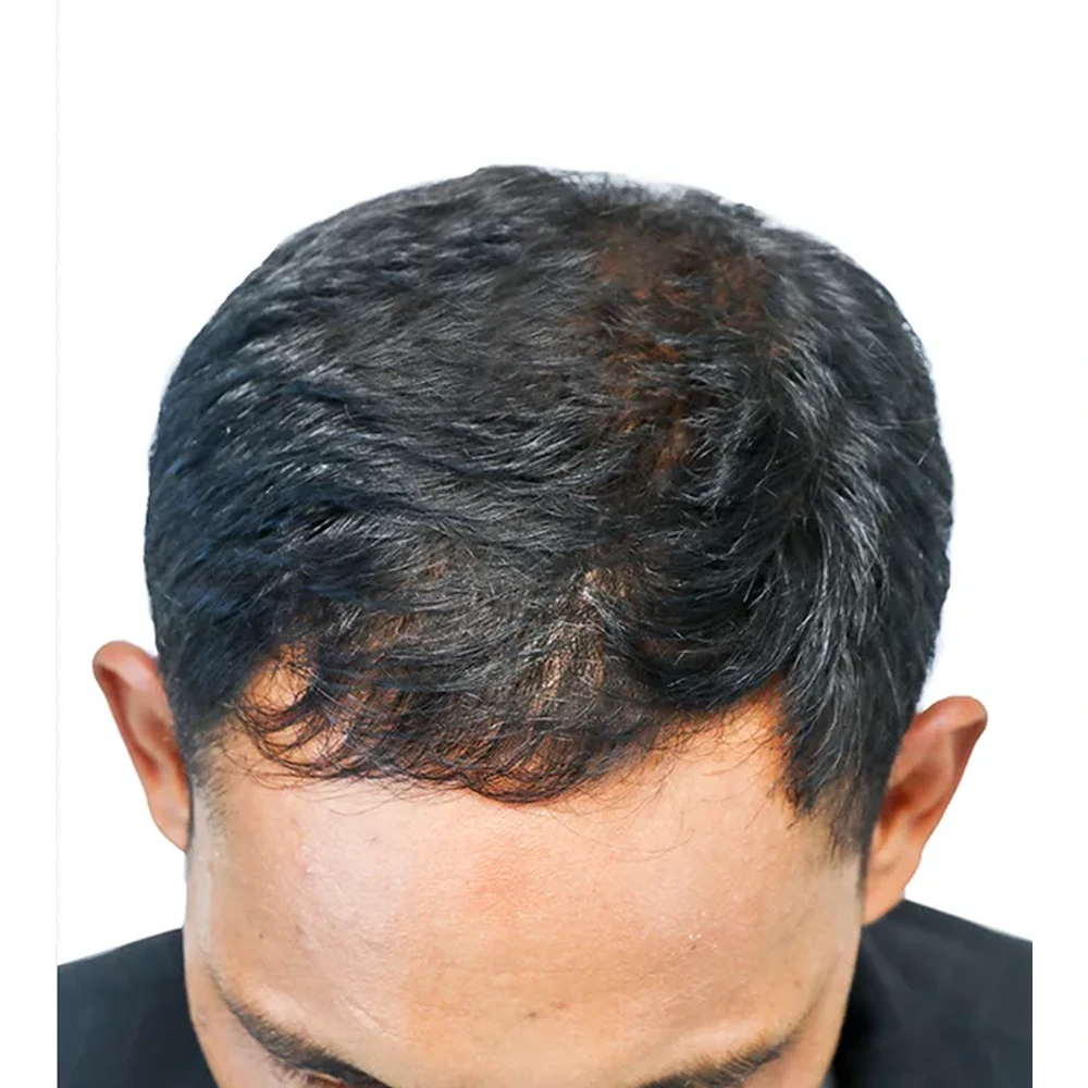 After PRP Hair Treatment