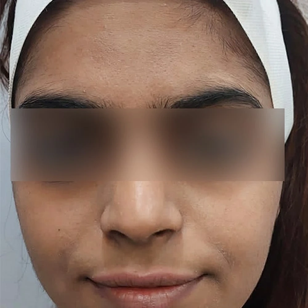 Before HydraFacial