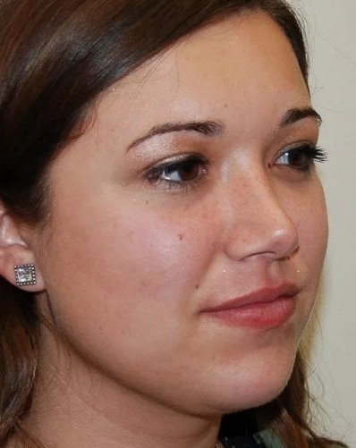 After Double Chin Treatment