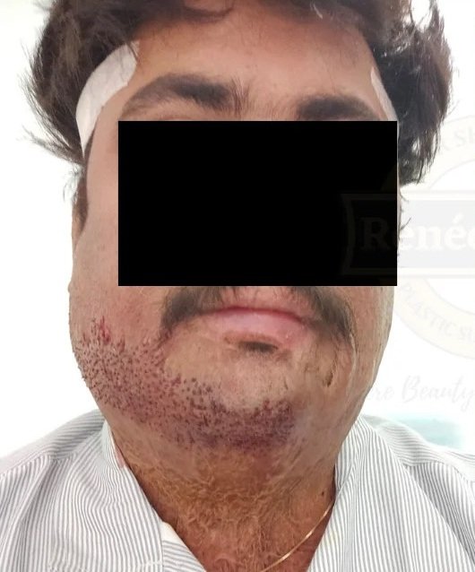 Before Beard Treatment