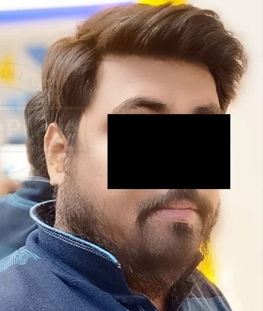 After Beard Treatment