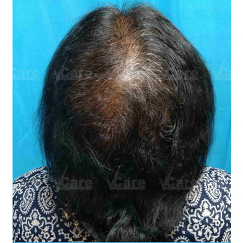 Before Exosome Hair Therapy