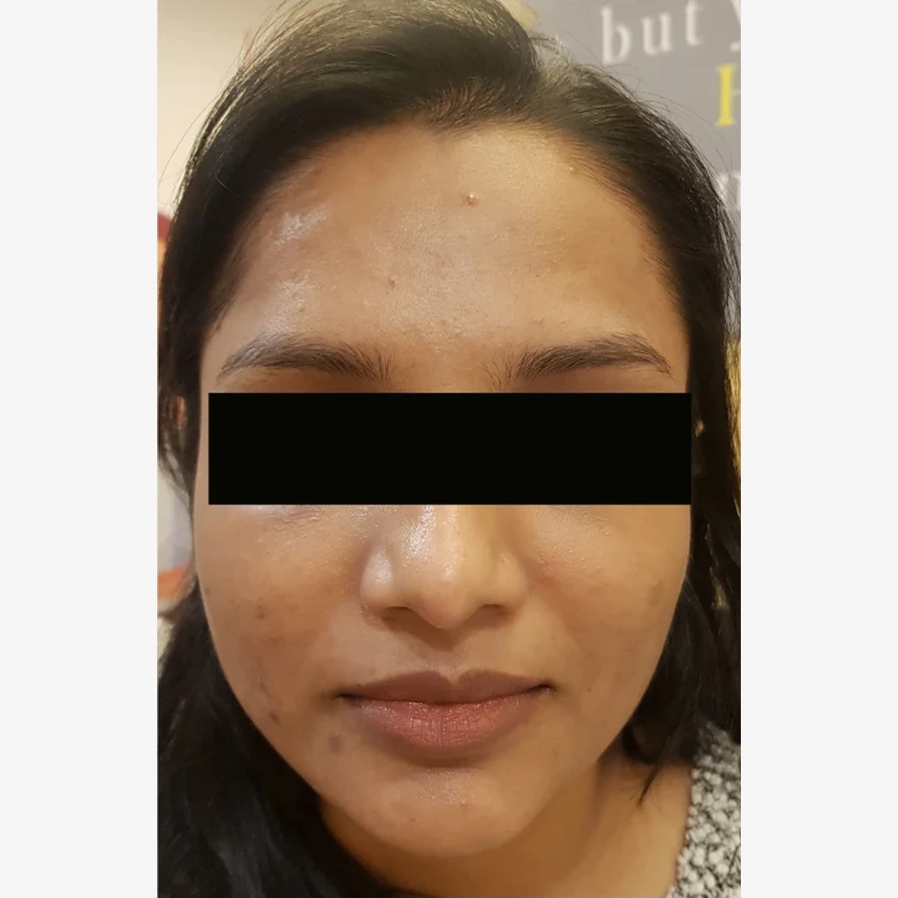 After Skin Whitening Treatment
