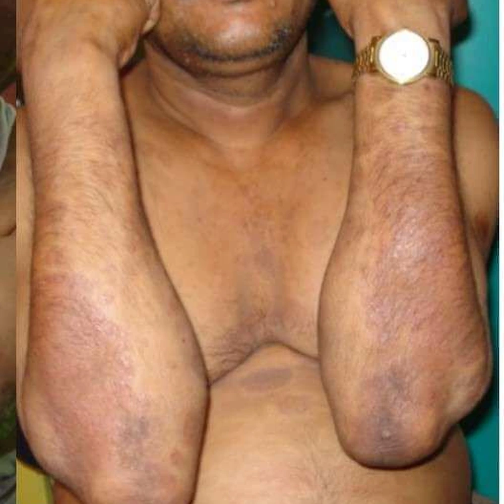 After Psoriasis Treatment