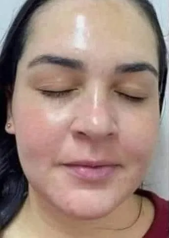 After Skin Rejuvenation