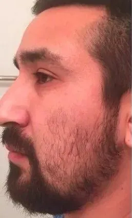 Before Beard Treatment