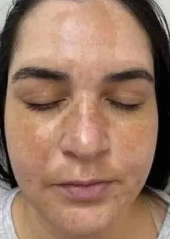 Before Skin Rejuvenation