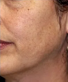 Before PRP Facial