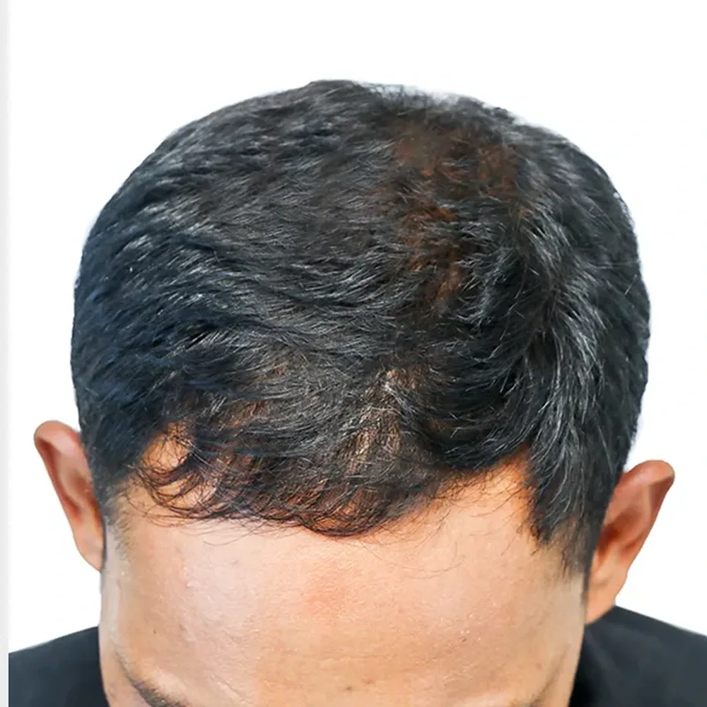 After Exosome Hair Therapy