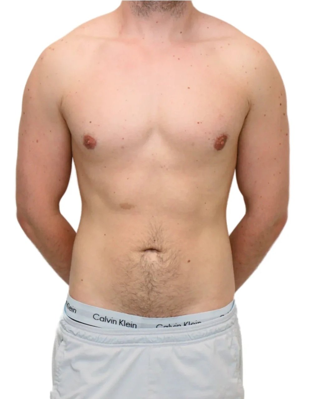 After Gynecomastia Surgery