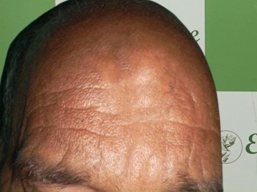 After Lipoma Treatment