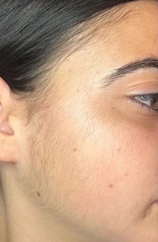 Before Laser Hair Removal