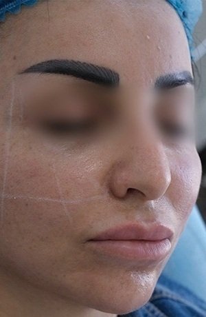Before Endolift Face Treatment