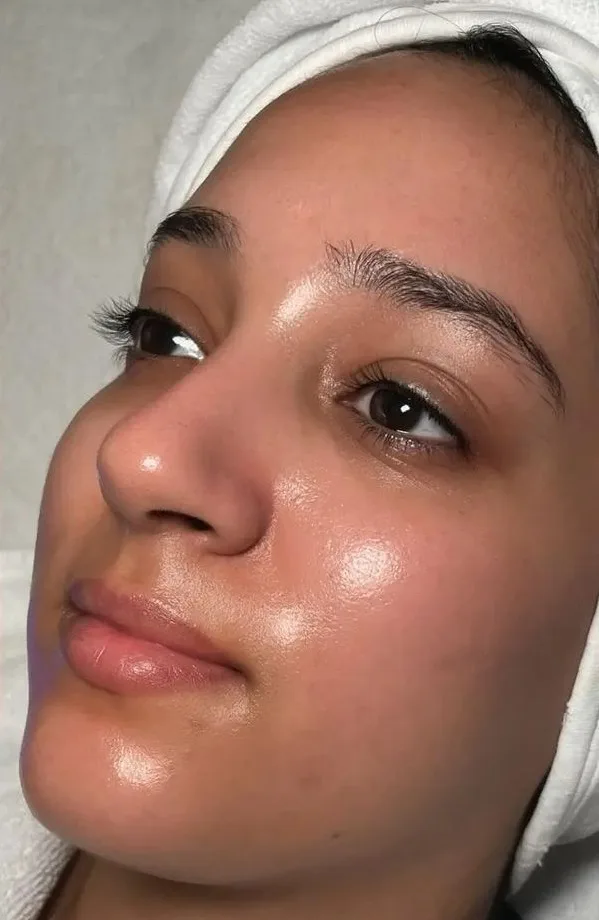 After HydraFacial