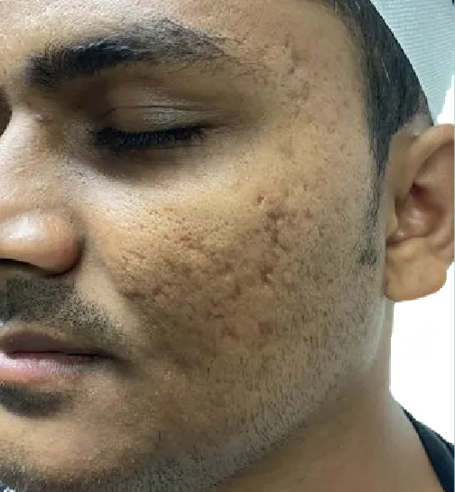CO2 Fractional Laser Resurfacing in Multan before treatment