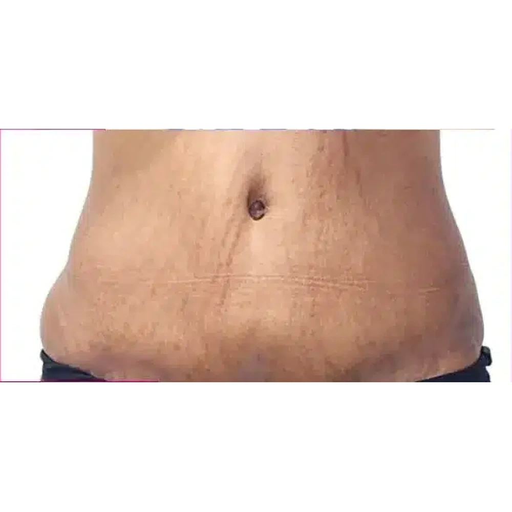 After Body Contouring