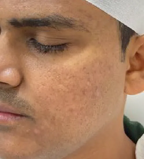 CO2 Fractional Laser Resurfacing in Multan after treatment