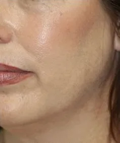 After PRP Facial