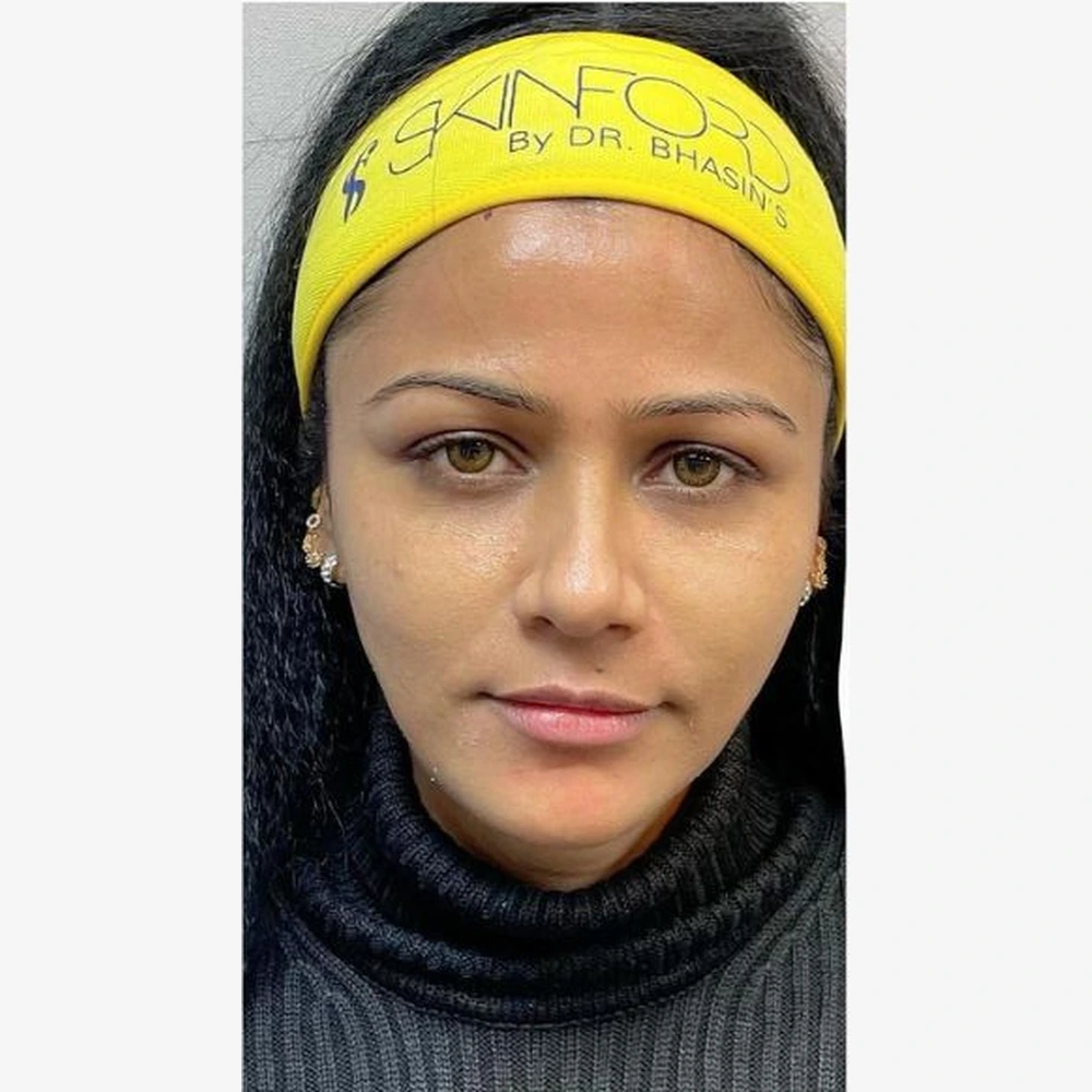 After Skin Rejuvenation