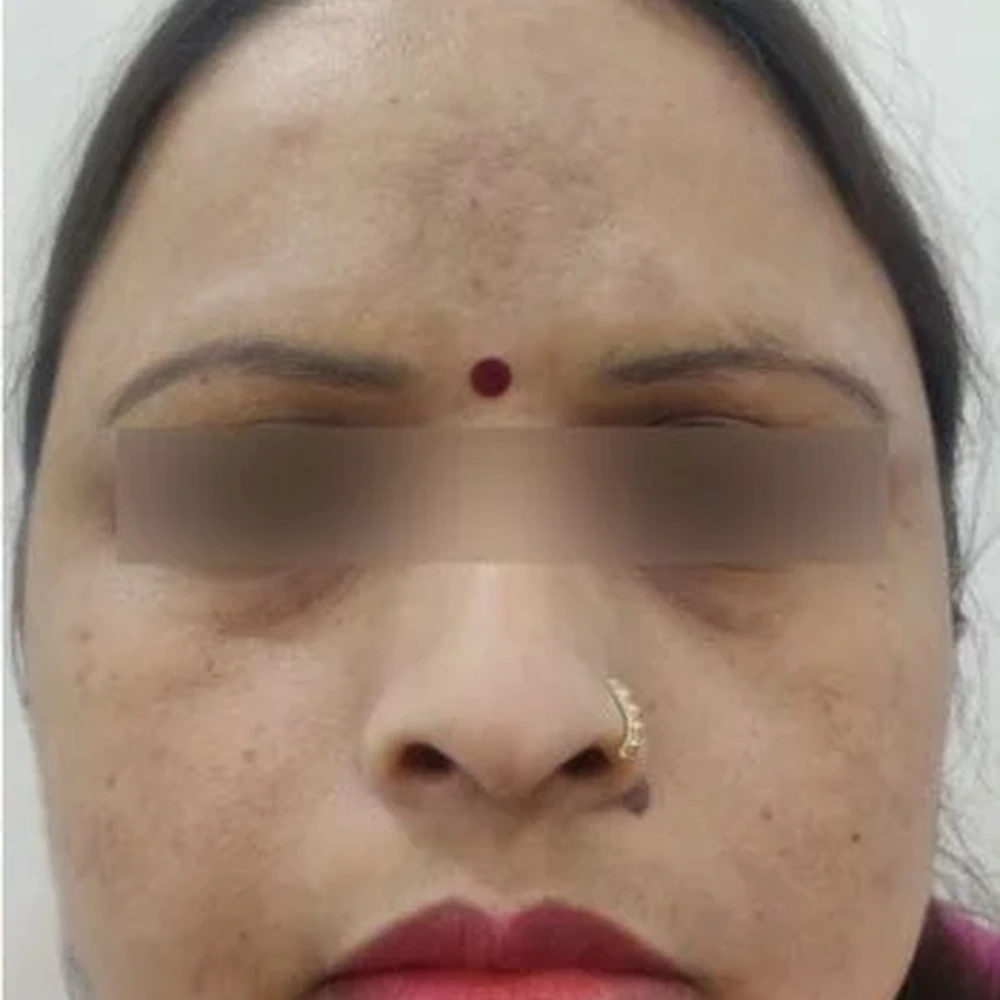 After Melasma Treatment