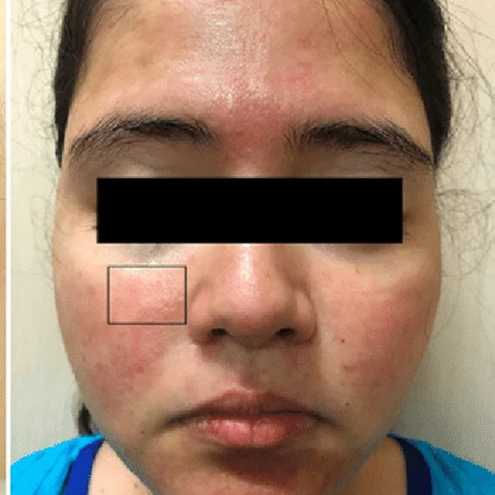 After Rosacea Treatment