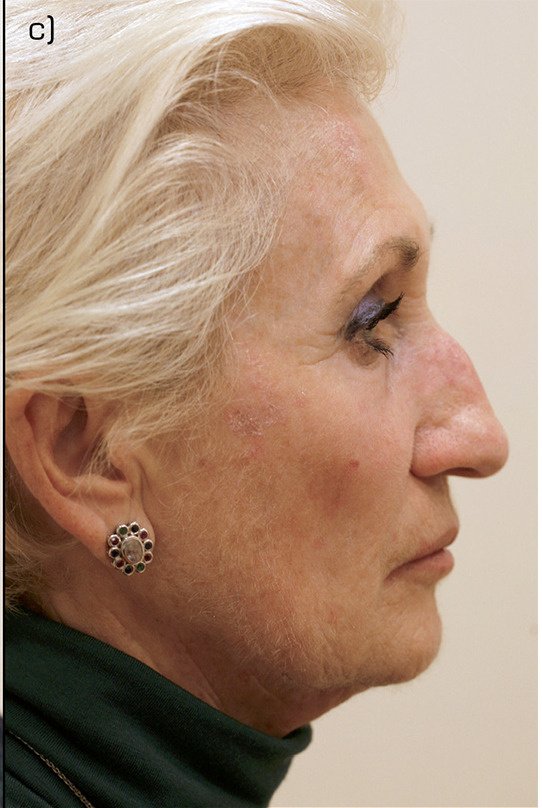 Before PRGF Skin Treatment