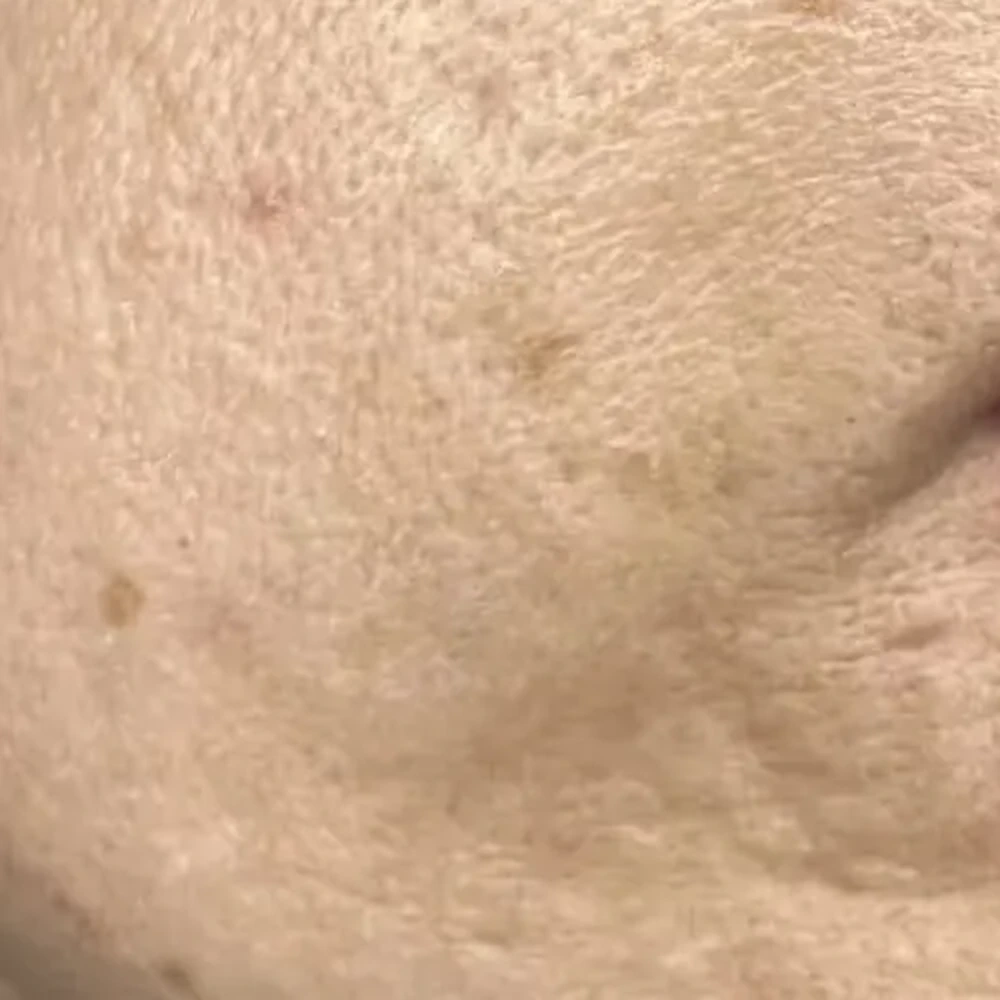 Before Laser Skin Treatment