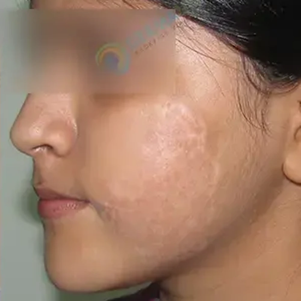 After Vitiligo Treatment