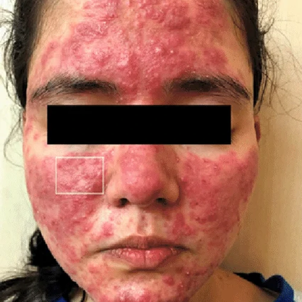 Before osacea Treatment
