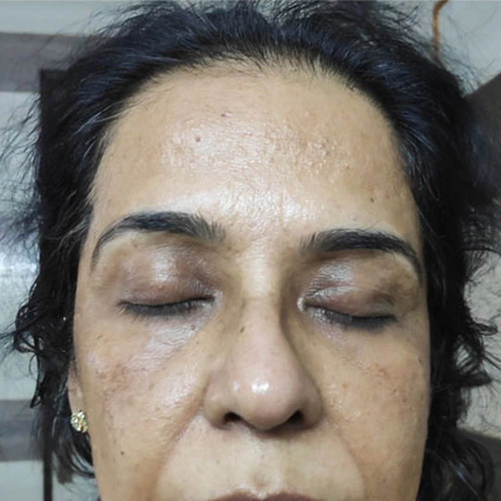 Before Carbon Laser