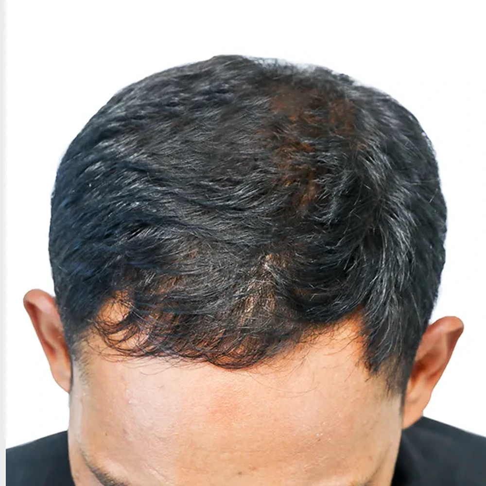 After Hair Loss Treatment