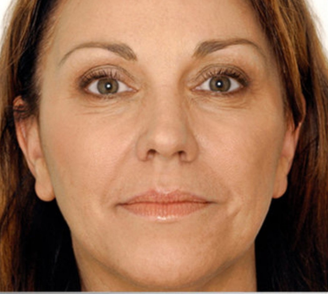 Before PRF Skin Treatment