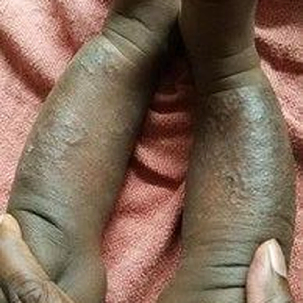 Before Eczema Treatment