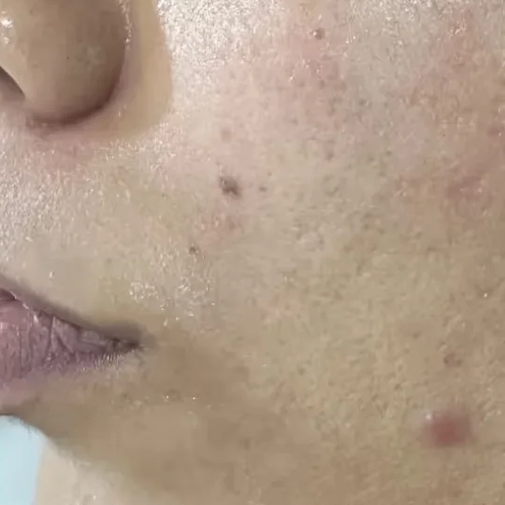 After Microneedling Dermapen, RF and Aftercare