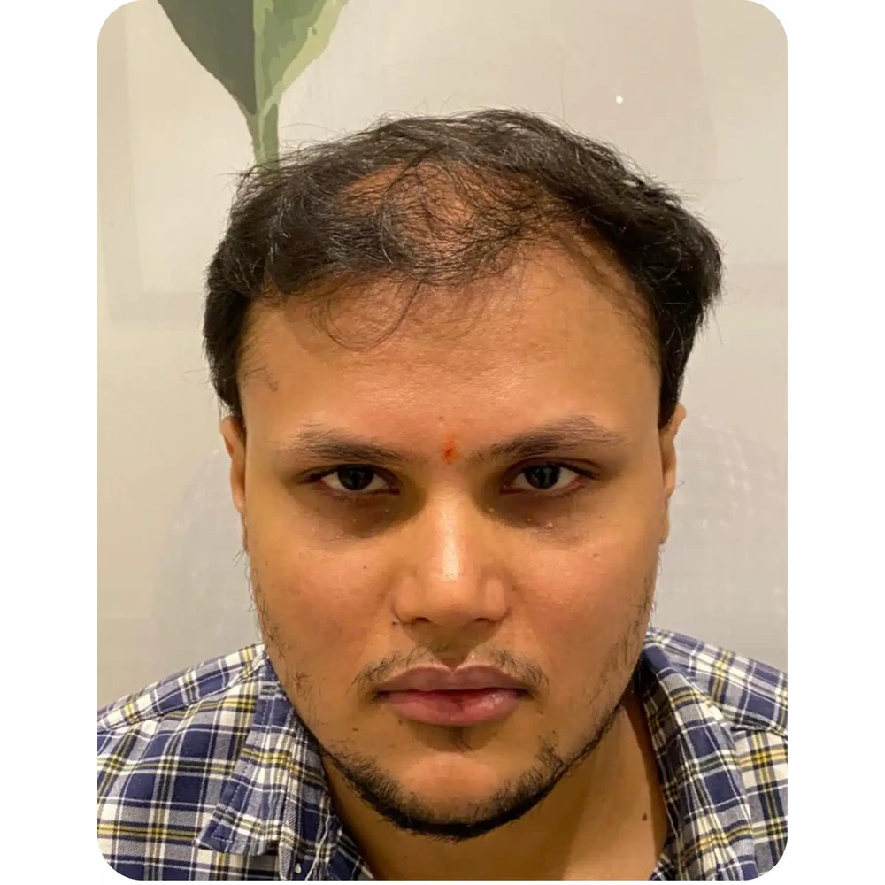 Alopecia Treatment in Multan before treatment