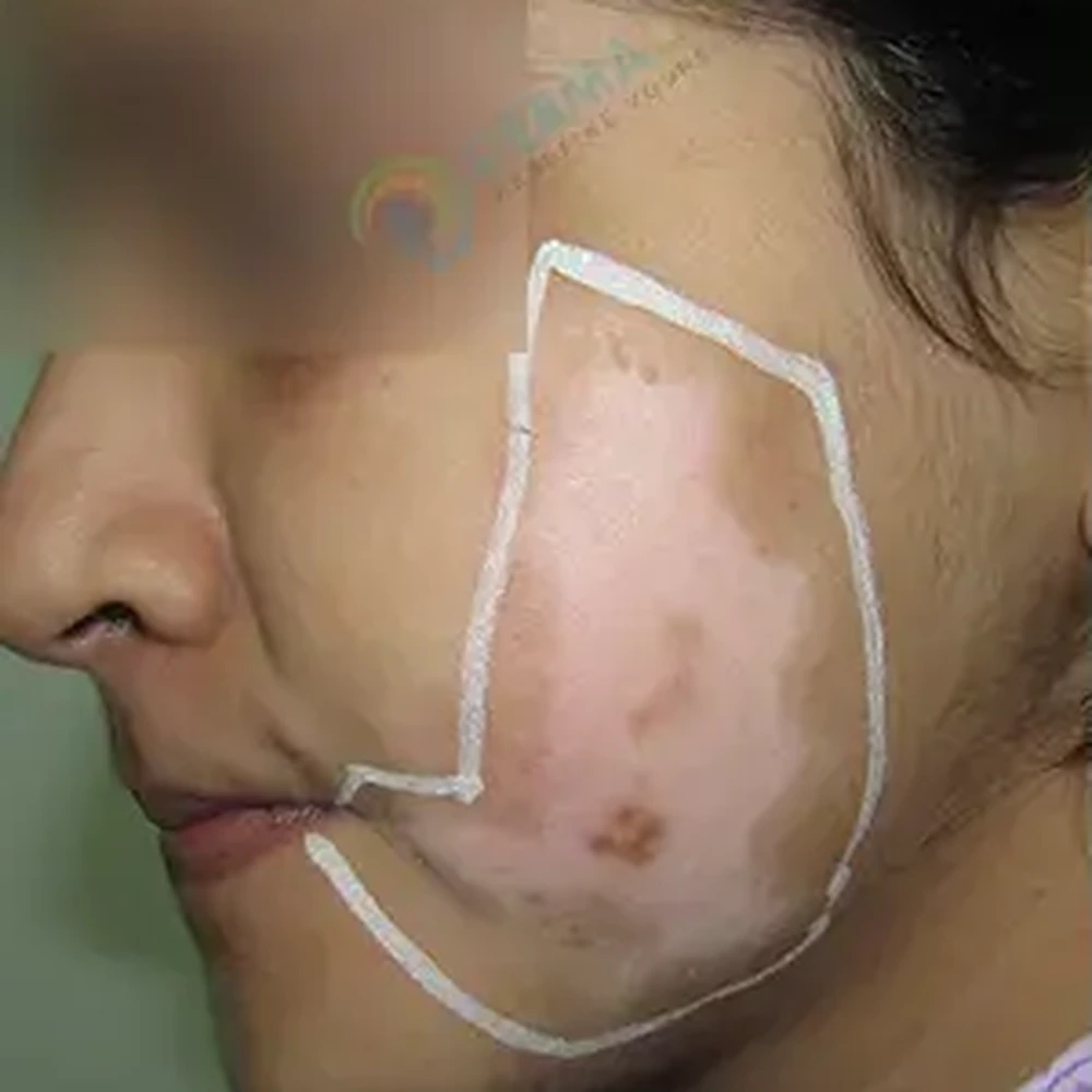 Before Vitiligo Treatment