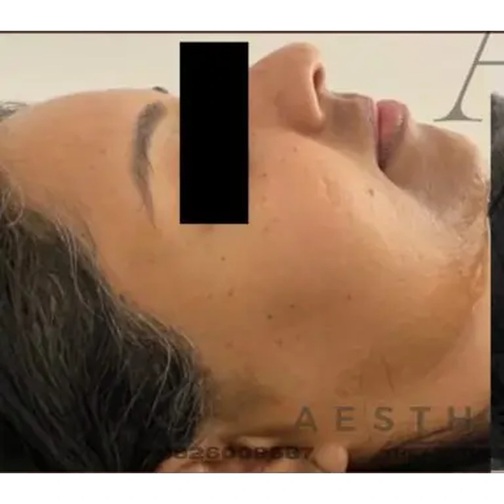 Before Non-Surgical Facelift
