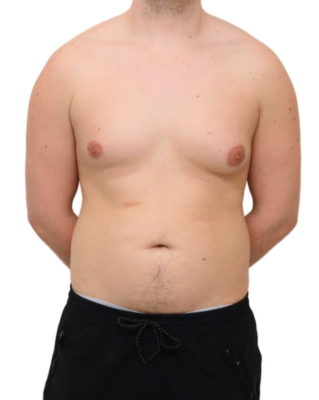 Before Gynecomastia Surgery