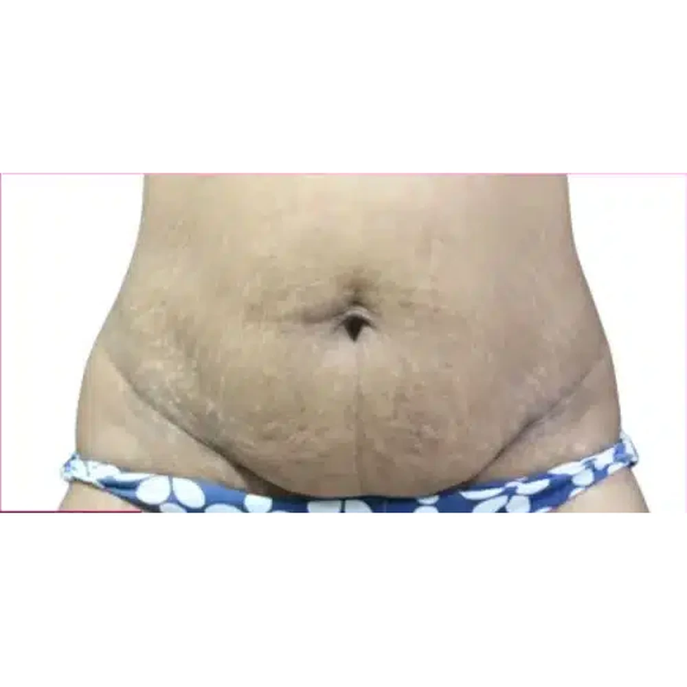 Before Body Contouring