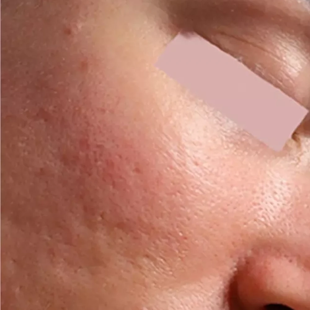 Before Open Pores Treatment