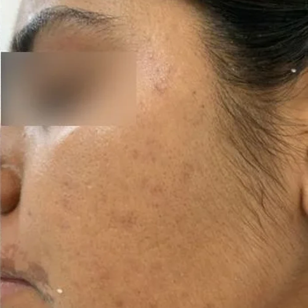 After Acne Treatment