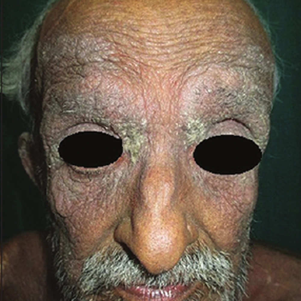 After Scabies Treatment