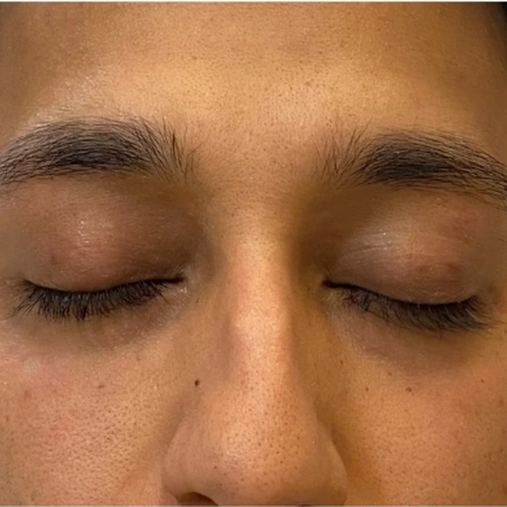 Before Eye Filler Treatment for Hollow Eyes