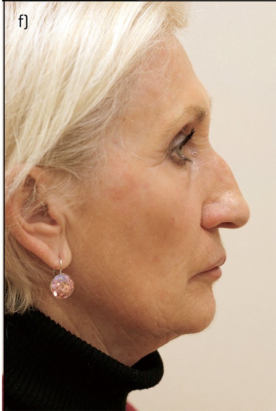 After PRGF Skin Treatment