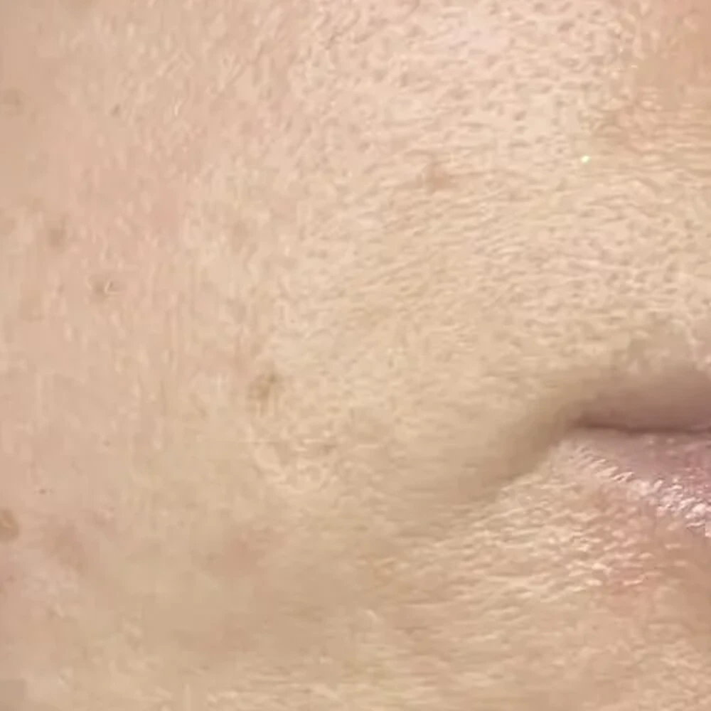 After Laser Skin Treatment